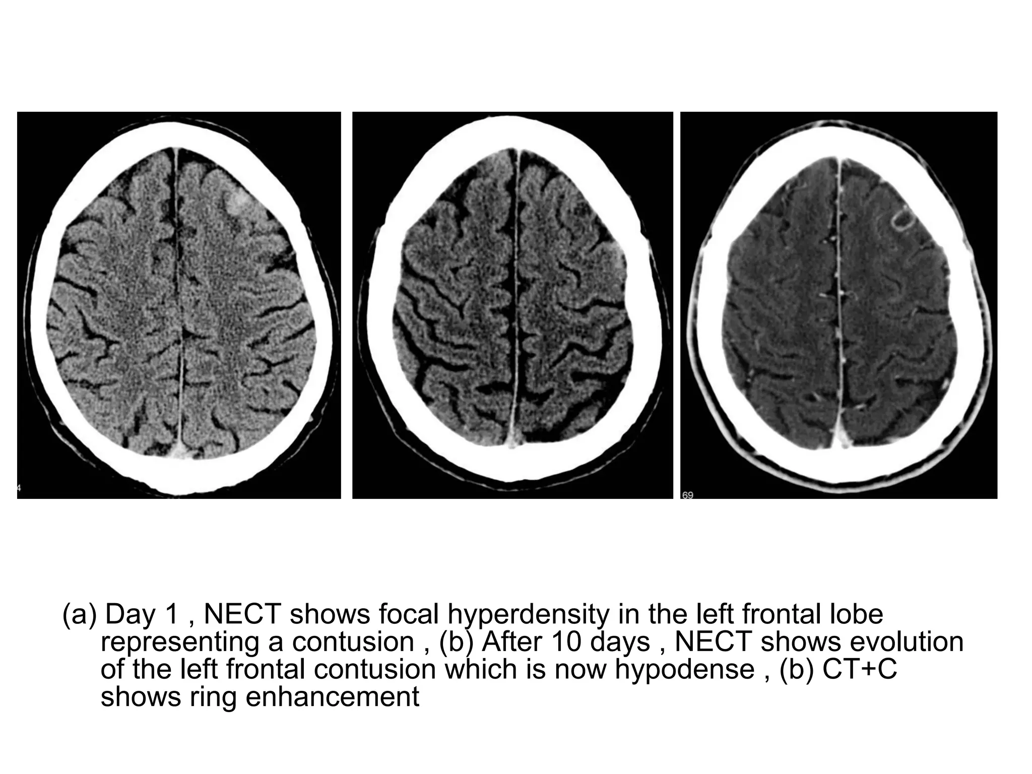 (a) Day 1 , NECT shows focal hyperdensity in the left frontal lobe
representing a contusion , (b) After 10 days , NECT shows evolution
of the left frontal contusion which is now hypodense , (b) CT+C
shows ring enhancement
 