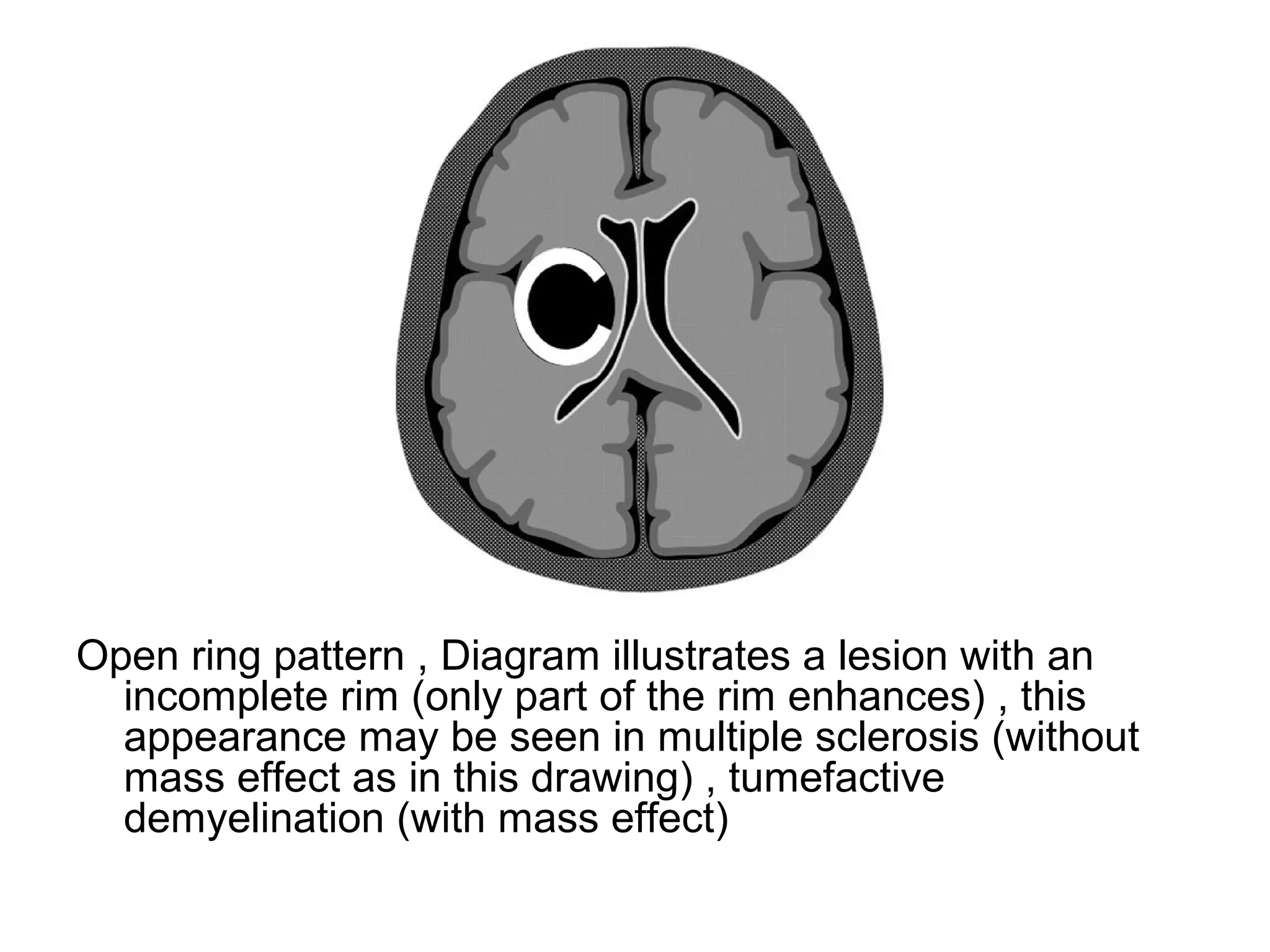 Open ring pattern , Diagram illustrates a lesion with an
incomplete rim (only part of the rim enhances) , this
appearance may be seen in multiple sclerosis (without
mass effect as in this drawing) , tumefactive
demyelination (with mass effect)
 