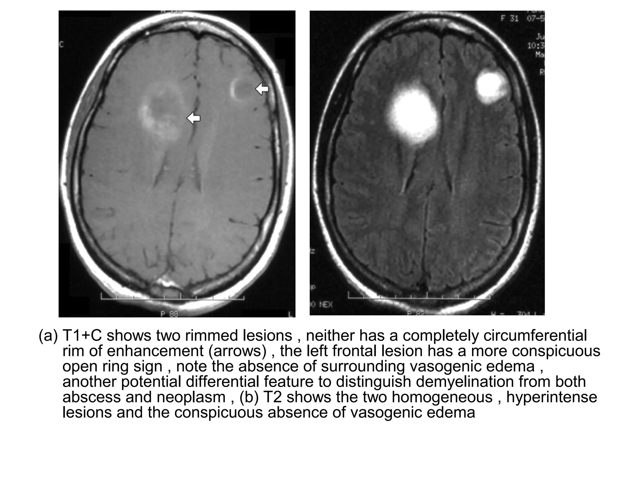 (a) T1+C shows two rimmed lesions , neither has a completely circumferential
rim of enhancement (arrows) , the left frontal lesion has a more conspicuous
open ring sign , note the absence of surrounding vasogenic edema ,
another potential differential feature to distinguish demyelination from both
abscess and neoplasm , (b) T2 shows the two homogeneous , hyperintense
lesions and the conspicuous absence of vasogenic edema
 