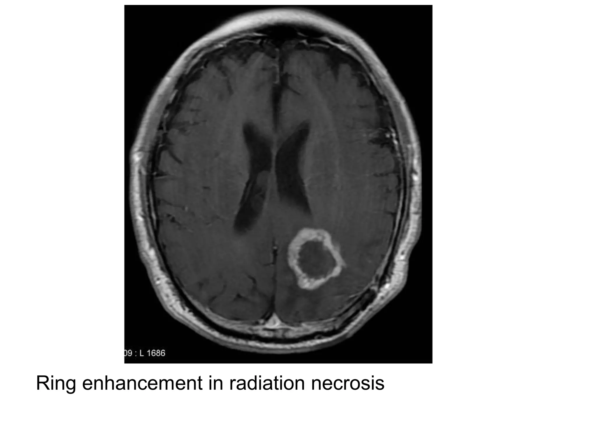 Ring enhancement in radiation necrosis
 