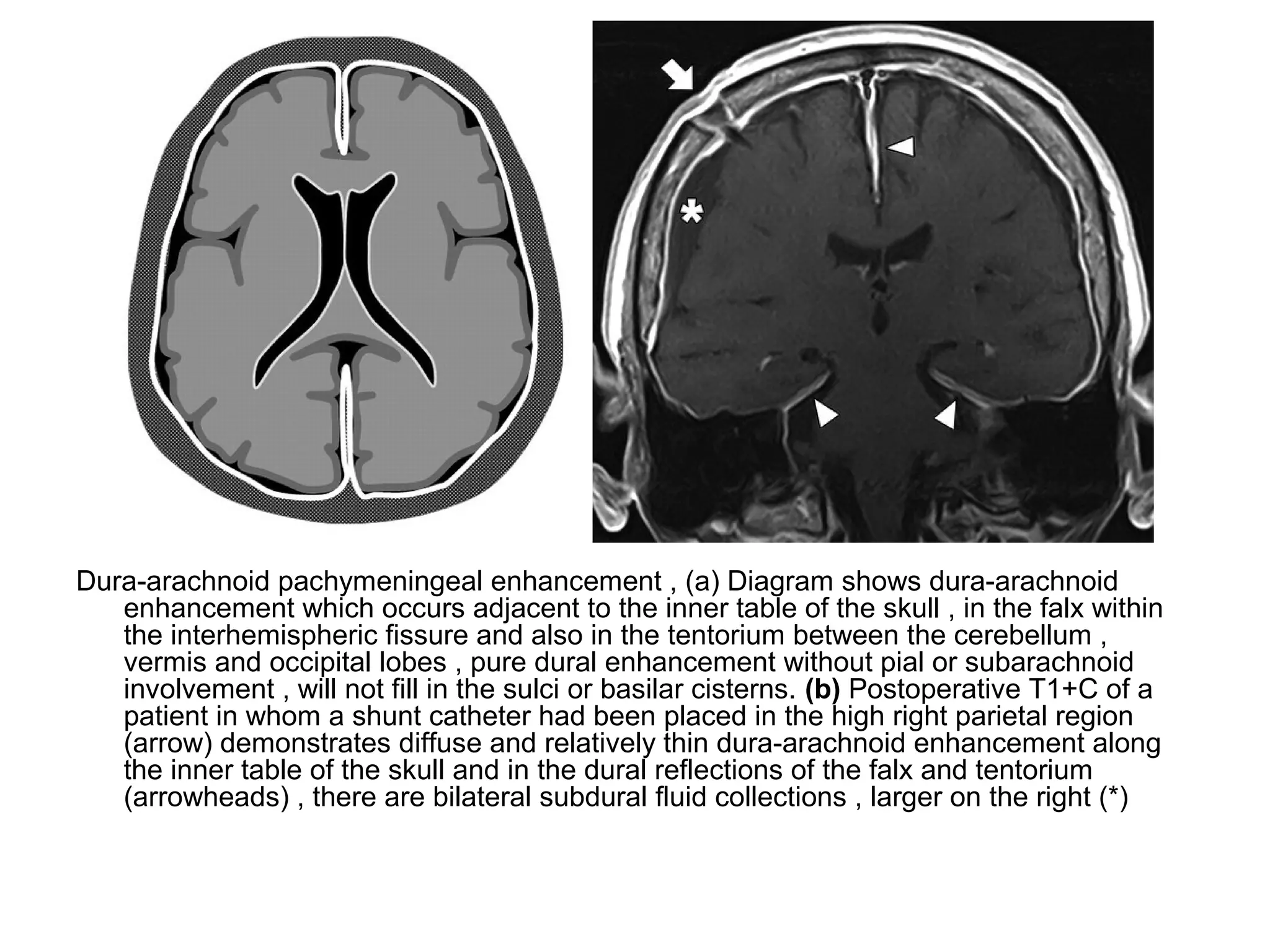 Dura-arachnoid pachymeningeal enhancement , (a) Diagram shows dura-arachnoid
enhancement which occurs adjacent to the inner table of the skull , in the falx within
the interhemispheric fissure and also in the tentorium between the cerebellum ,
vermis and occipital lobes , pure dural enhancement without pial or subarachnoid
involvement , will not fill in the sulci or basilar cisterns. (b) Postoperative T1+C of a
patient in whom a shunt catheter had been placed in the high right parietal region
(arrow) demonstrates diffuse and relatively thin dura-arachnoid enhancement along
the inner table of the skull and in the dural reflections of the falx and tentorium
(arrowheads) , there are bilateral subdural fluid collections , larger on the right (*)
 