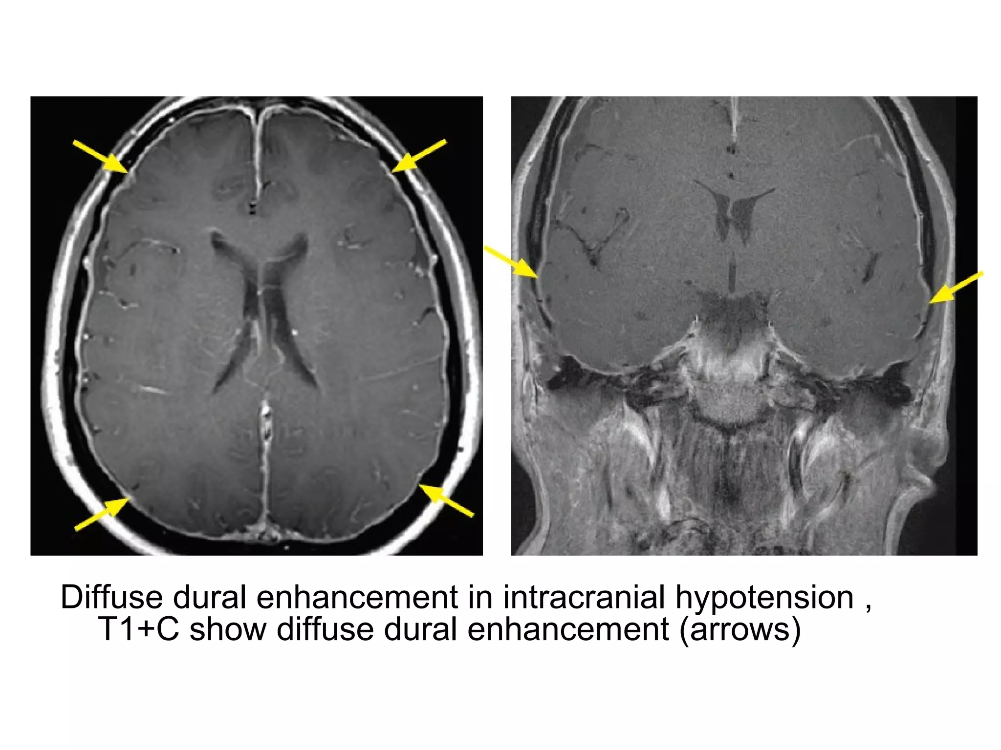 Diffuse dural enhancement in intracranial hypotension ,
T1+C show diffuse dural enhancement (arrows)
 