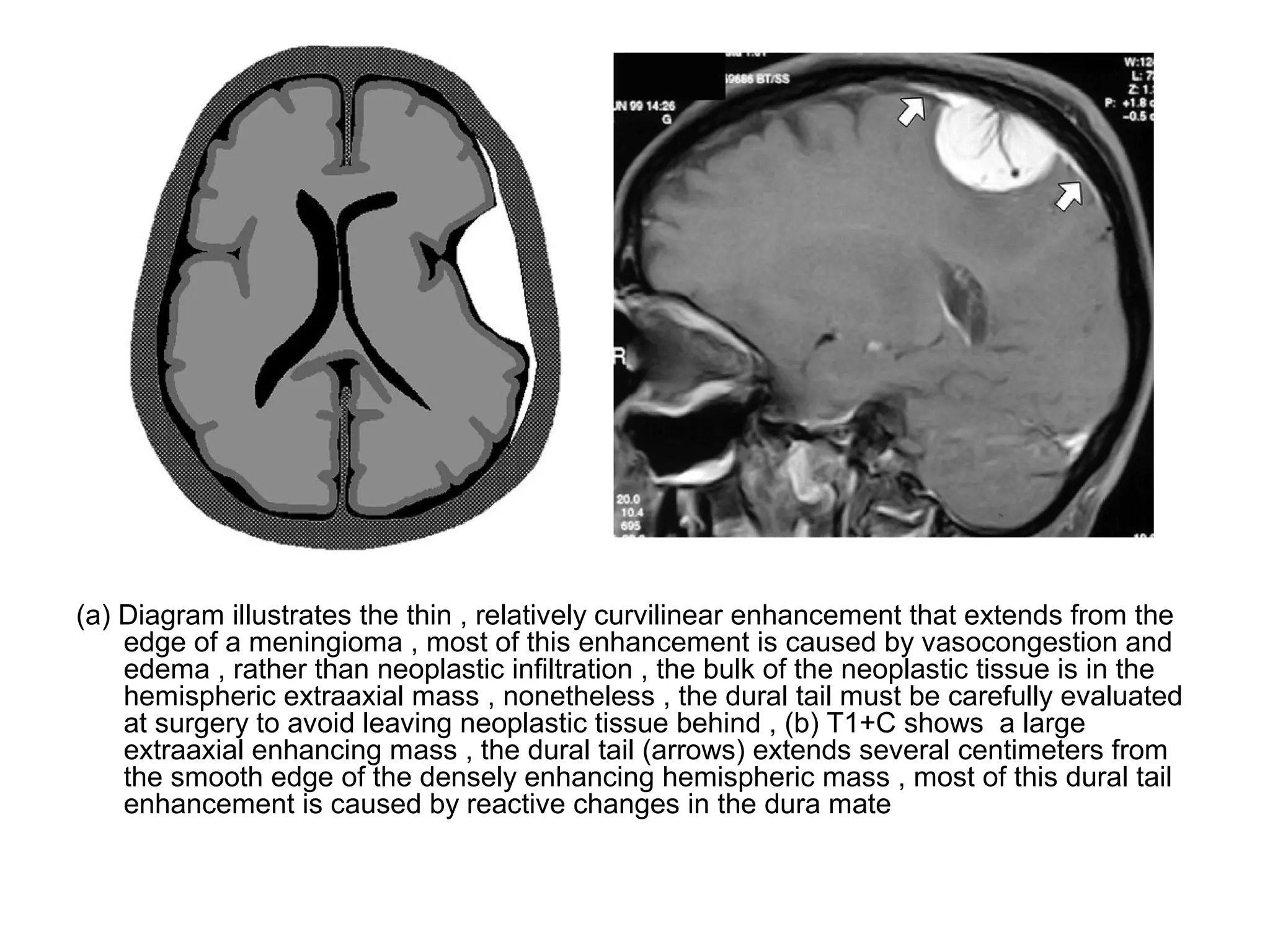(a) Diagram illustrates the thin , relatively curvilinear enhancement that extends from the
edge of a meningioma , most of this enhancement is caused by vasocongestion and
edema , rather than neoplastic infiltration , the bulk of the neoplastic tissue is in the
hemispheric extraaxial mass , nonetheless , the dural tail must be carefully evaluated
at surgery to avoid leaving neoplastic tissue behind , (b) T1+C shows a large
extraaxial enhancing mass , the dural tail (arrows) extends several centimeters from
the smooth edge of the densely enhancing hemispheric mass , most of this dural tail
enhancement is caused by reactive changes in the dura mate
 