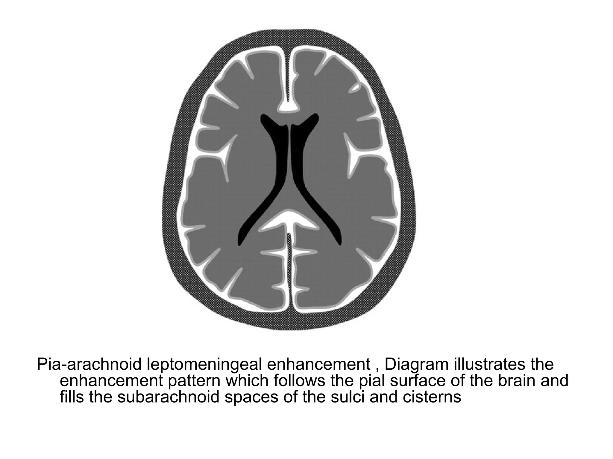 Pia-arachnoid leptomeningeal enhancement , Diagram illustrates the
enhancement pattern which follows the pial surface of the brain and
fills the subarachnoid spaces of the sulci and cisterns
 