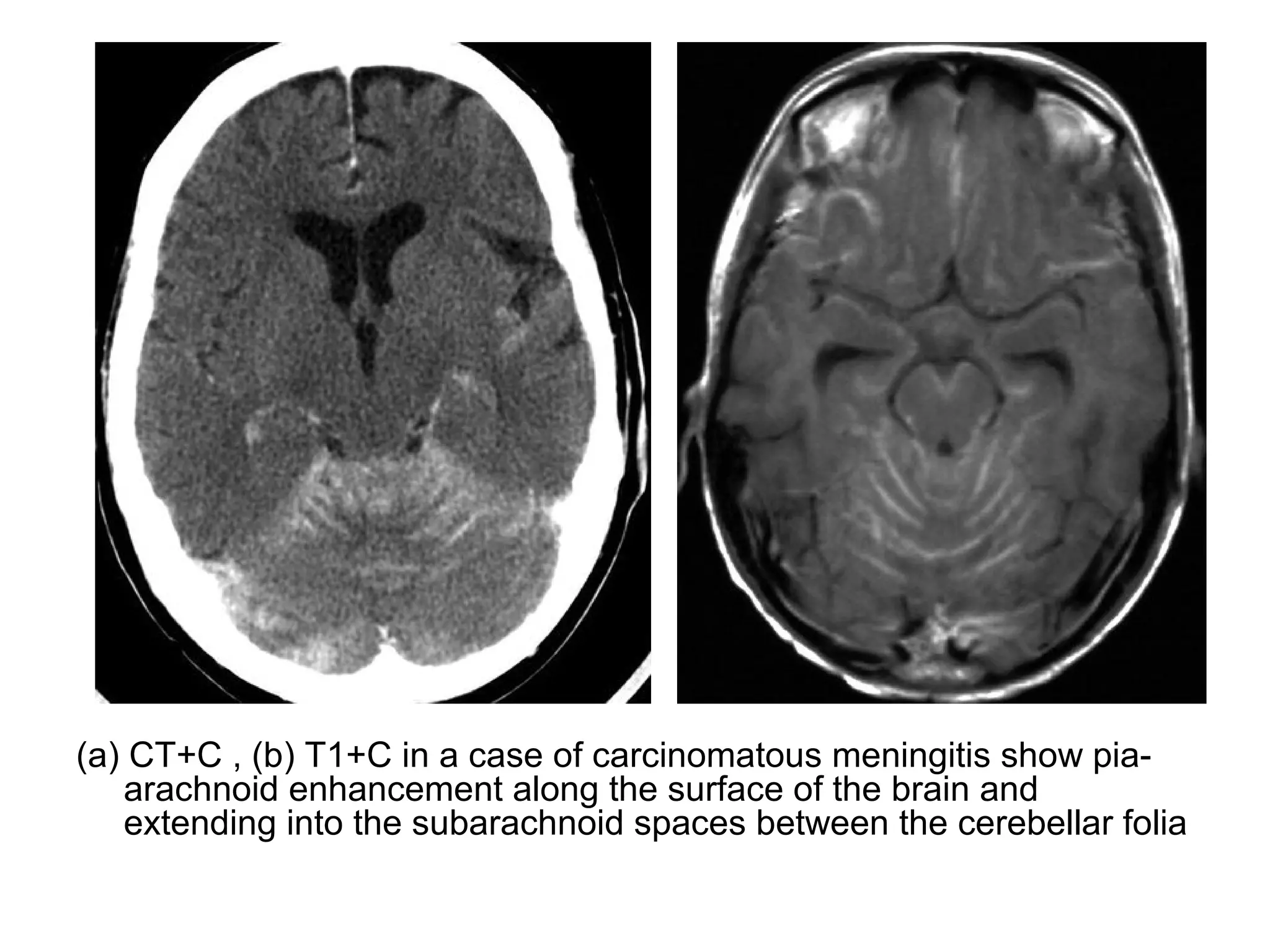 (a) CT+C , (b) T1+C in a case of carcinomatous meningitis show pia-
arachnoid enhancement along the surface of the brain and
extending into the subarachnoid spaces between the cerebellar folia
 