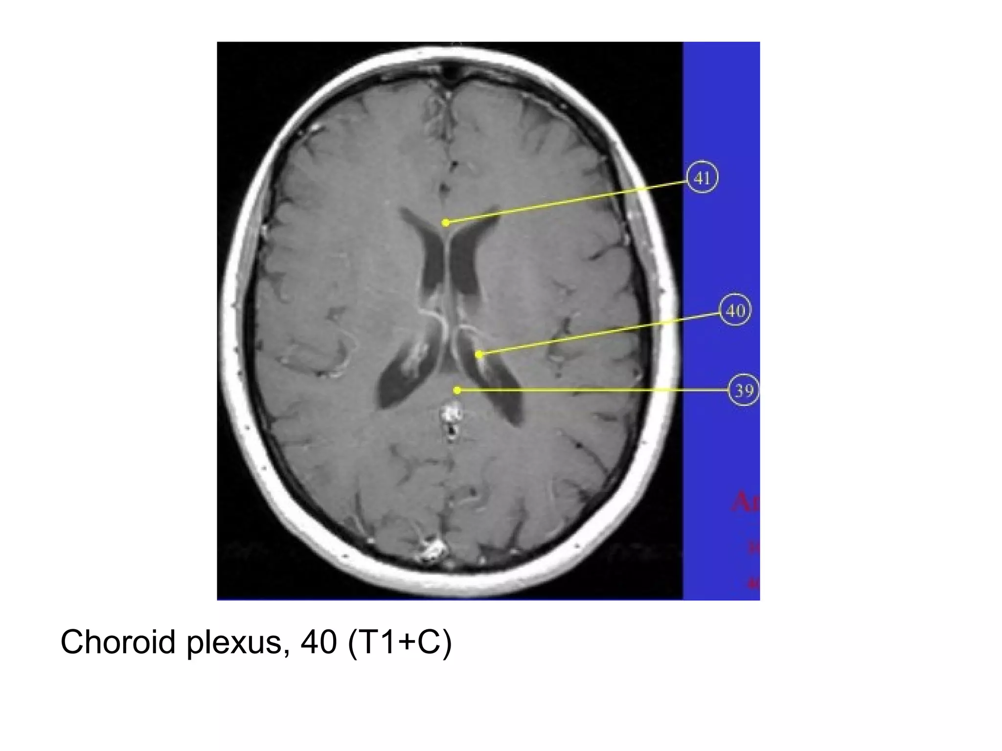 Choroid plexus, 40 (T1+C)
 
