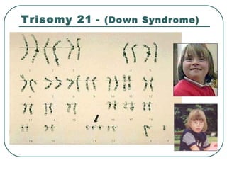 Trisomy 21 - (Down Syndrome)
 