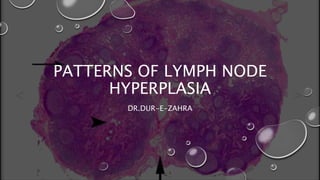PATTERNS OF LYMPH NODE
HYPERPLASIA
DR.DUR-E-ZAHRA
 