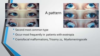 Pattern strabismus | PPTX