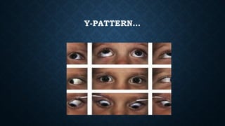 Assessment and management of Pattern Strabismus | PPTX
