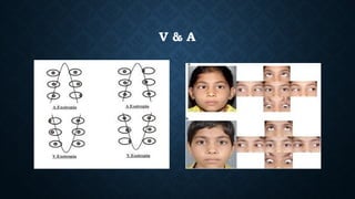 Assessment and management of Pattern Strabismus | PPTX