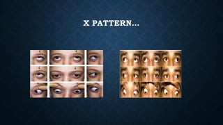 Assessment and management of Pattern Strabismus | PPTX