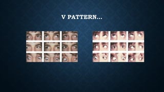 Assessment and management of Pattern Strabismus | PPTX