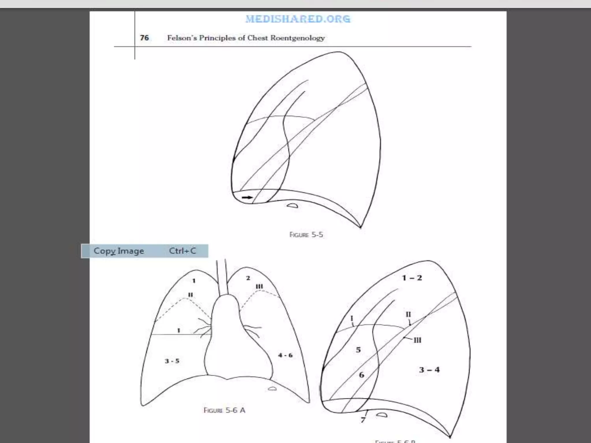 Lung Radiograph Patterns Patttern of lung disease on chest x ray | PPTX