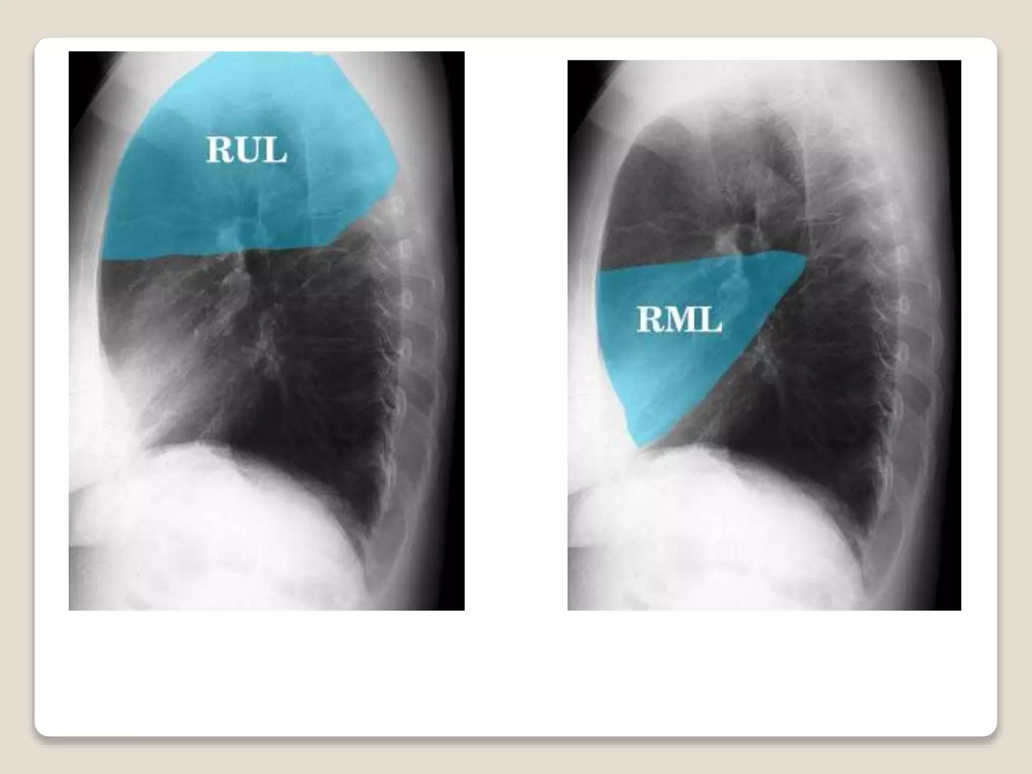 Lung Radiograph Patterns Patttern of lung disease on chest x ray | PPTX