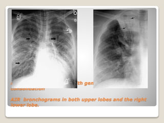 Patttern of lung disease on chest x ray | PPTX