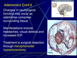 Adenoma’s Cont’d
Changes in neurological
function may occur as
adenomas compress
surrounding tissue.
Manifestations include
headaches, visual defects and
increased ICP.
Treatment is surgical resection
through transphenoidal
hypophysectomy
 