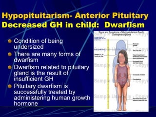 Hypopituitarism- Anterior Pituitary
Decreased GH in child: Dwarfism
Condition of being
undersized
There are many forms of
dwarfism
Dwarfism related to pituitary
gland is the result of
insufficient GH
Pituitary dwarfism is
successfully treated by
administering human growth
hormone
 