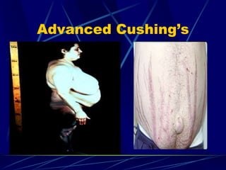 Advanced Cushing’s
 