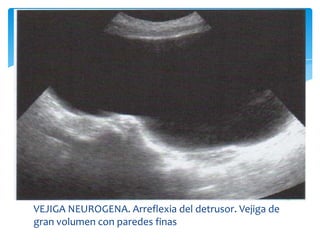 Patología Vesical por Ultrasonido Slide 137