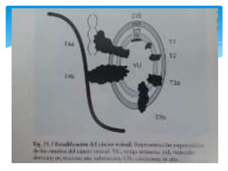 Patología Vesical por Ultrasonido Slide 92