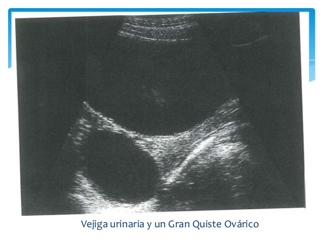 Patología Vesical por Ultrasonido