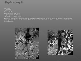 Περίπτωση 1Περίπτωση 1ηη
•Άρρεν
•53 ετών
•Κοιλιακό άλγος
•Ψευδοανεύρυσμα
•Σωληνωτή ενδοπροθέση (Σκέλος Μοσχεύματος 20 X 80mm Endurarnt
Medronic)
 