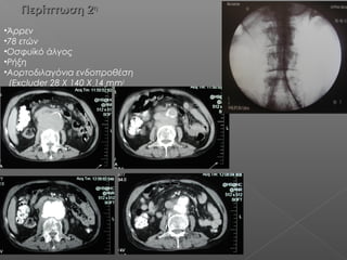 Περίπτωση 2Περίπτωση 2ηη
•Άρρεν
•78 ετών
•Οσφυϊκό άλγος
•Ρήξη
•Αορτοδιλαγόνια ενδοπροθέση
(Excluder 28 Χ 140 Χ 14 mm)
•
 
