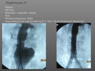 Περίπτωση 3Περίπτωση 3ηη
•Άρρεν
•62 ετών
•Κοιλιακό – οσφυϊκό άλγος
•Σοκ
•Ψευδοανεύρυσμα -Ρήξη
•Αορτοδιλαγόνια ενδοπροθέση(25 X 145 x 13mm Endurarnt Medronic)
 