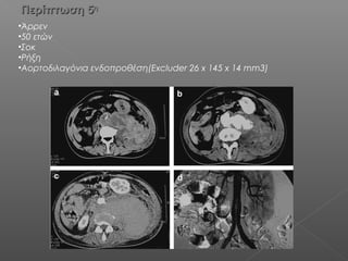 Περίπτωση 5Περίπτωση 5ηη
•Άρρεν
•50 ετών
•Σοκ
•Ρήξη
•Αορτοδιλαγόνια ενδοπροθέση(Excluder 26 x 145 x 14 mm3)
 