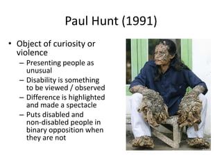 Paul Hunt (1991) 
• Object of curiosity or 
violence 
– Presenting people as 
unusual 
– Disability is something 
to be viewed / observed 
– Difference is highlighted 
and made a spectacle 
– Puts disabled and 
non-disabled people in 
binary opposition when 
they are not 
 