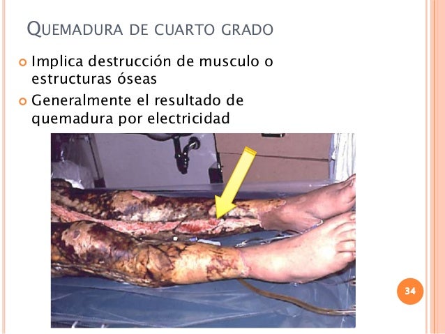 P aux 19 - quemaduras-generalidades P aux 19 - quemaduras-generalidades