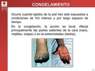 110
CONGELAMIENTO
Ocurre cuando tejidos de la piel han sido expuestos a
condiciones de frío intenso y por largo espacio de
tiempo.
En la congelación, la acción es local. Afecta
principalmente las partes salientes de la cara (nariz,
mejillas, orejas) o en la extremidades (dedos).
 