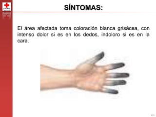111
El área afectada toma coloración blanca grisácea, con
intenso dolor si es en los dedos, indoloro si es en la
cara.
SÍNTOMAS:
 