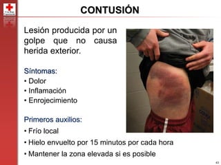 43
CONTUSIÓN
Lesión producida por un
golpe que no causa
herida exterior.
Síntomas:
• Dolor
• Inflamación
• Enrojecimiento
Primeros auxilios:
• Frío local
• Hielo envuelto por 15 minutos por cada hora
• Mantener la zona elevada si es posible
 