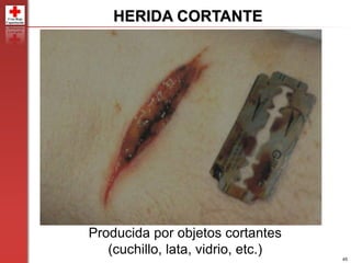 45
HERIDA CORTANTE
Producida por objetos cortantes
(cuchillo, lata, vidrio, etc.)
 