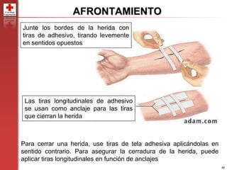 46
AFRONTAMIENTO
Para cerrar una herida, use tiras de tela adhesiva aplicándolas en
sentido contrario. Para asegurar la cerradura de la herida, puede
aplicar tiras longitudinales en función de anclajes
Junte los bordes de la herida con
tiras de adhesivo, tirando levemente
en sentidos opuestos
Las tiras longitudinales de adhesivo
se usan como anclaje para las tiras
que cierran la herida
 