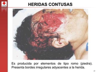 47
Es producida por elementos de tipo romo (piedra).
Presenta bordes irregulares adyacentes a la herida.
HERIDAS CONTUSAS
 