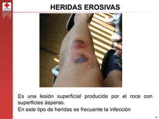 50
Es una lesión superficial producida por el roce con
superficies ásperas.
En este tipo de heridas es frecuente la infección
HERIDAS EROSIVAS
 