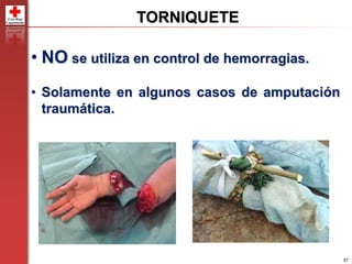 57
• NO se utiliza en control de hemorragias.
• Solamente en algunos casos de amputación
traumática.
TORNIQUETE
 