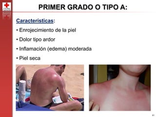 61
PRIMER GRADO O TIPO A:
Características:
• Enrojecimiento de la piel
• Dolor tipo ardor
• Inflamación (edema) moderada
• Piel seca
 