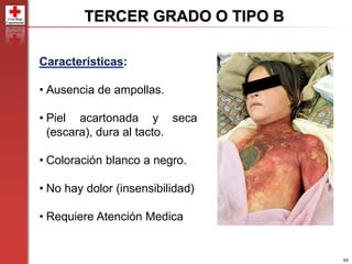 65
TERCER GRADO O TIPO B
Características:
• Ausencia de ampollas.
• Piel acartonada y seca
(escara), dura al tacto.
• Coloración blanco a negro.
• No hay dolor (insensibilidad)
• Requiere Atención Medica
 