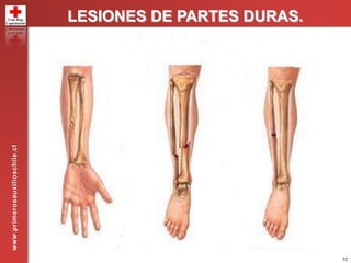 72
LESIONES DE PARTES DURAS.www.primerosauxilioschile.cl
 