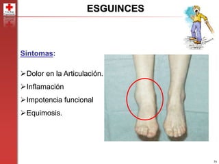74
ESGUINCES
Síntomas:
Dolor en la Articulación.
Inflamación
Impotencia funcional
Equimosis.
 