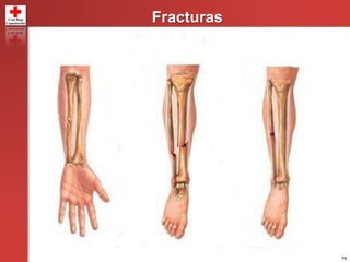 78
Fracturas
 