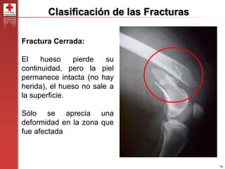 79
Clasificación de las Fracturas
Fractura Cerrada:
El hueso pierde su
continuidad, pero la piel
permanece intacta (no hay
herida), el hueso no sale a
la superficie.
Sólo se aprecia una
deformidad en la zona que
fue afectada
 