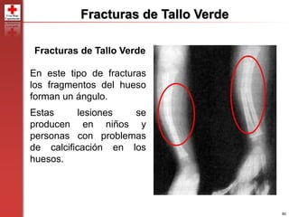80
Fracturas de Tallo Verde
En este tipo de fracturas
los fragmentos del hueso
forman un ángulo.
Estas lesiones se
producen en niños y
personas con problemas
de calcificación en los
huesos.
Fracturas de Tallo Verde
 