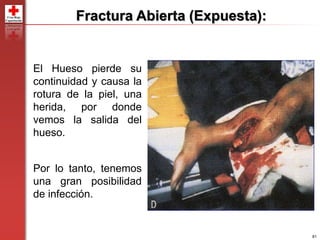 81
Fractura Abierta (Expuesta):
El Hueso pierde su
continuidad y causa la
rotura de la piel, una
herida, por donde
vemos la salida del
hueso.
Por lo tanto, tenemos
una gran posibilidad
de infección.
 