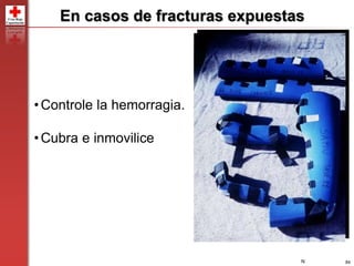 84
•Controle la hemorragia.
•Cubra e inmovilice
En casos de fracturas expuestas
N
 