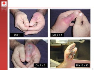 94
Día 1 Día 3 a 4
Día 7 a 8 Día 13 a 15
 